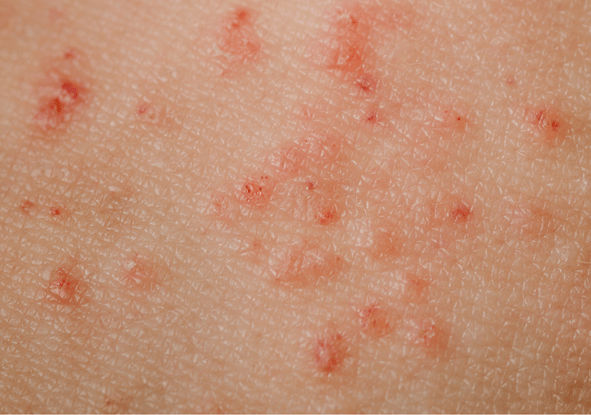 Skin Conditions (Eczema, Psoriasis, Acne)